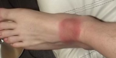 Rougeurs qui apparaissent après une piqûre de tique infectée, donnant lieu à la maladie de Lyme