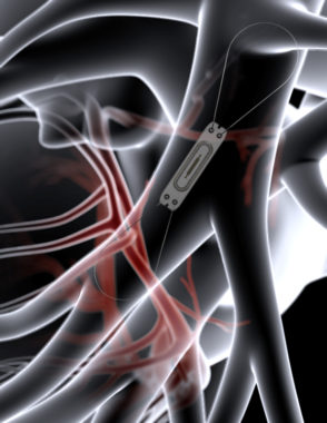 Représentation du capteur CardioMEMS, implanté dans une artère pulmonaire. © Chuga